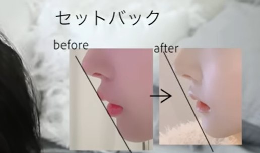 Rちゃん　整形前　昔の顔