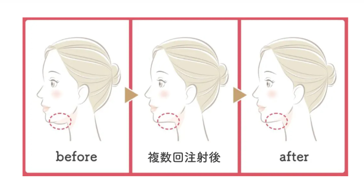 脂肪溶解注射