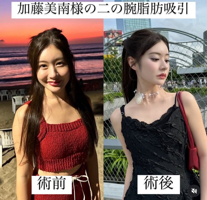 加藤美南　鼻整形
