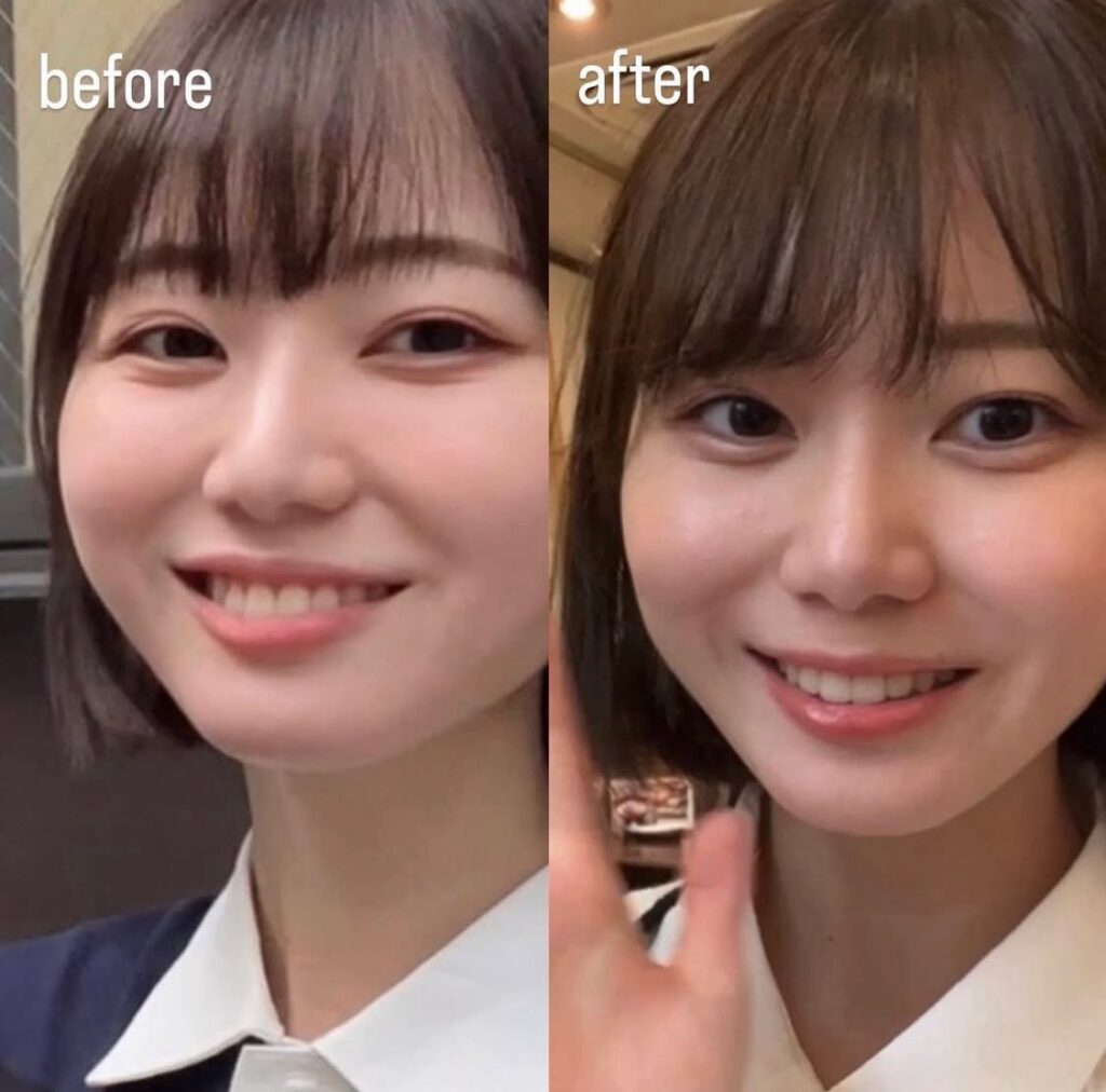 いけちゃん　整形
