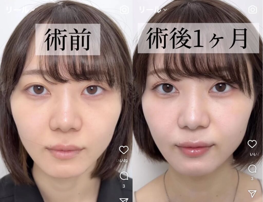 いけちゃん　整形