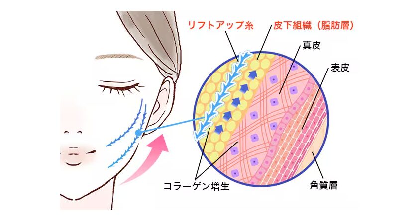 いけちゃん　整形