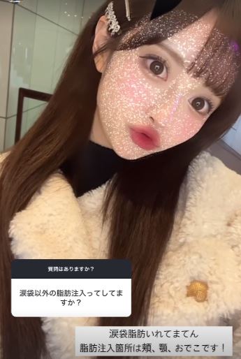 にじほ 整形 顔変わった