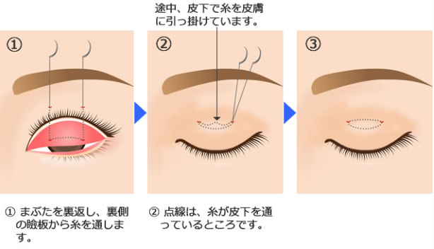 【ラブトラ3】しおり　整形　顔変わった