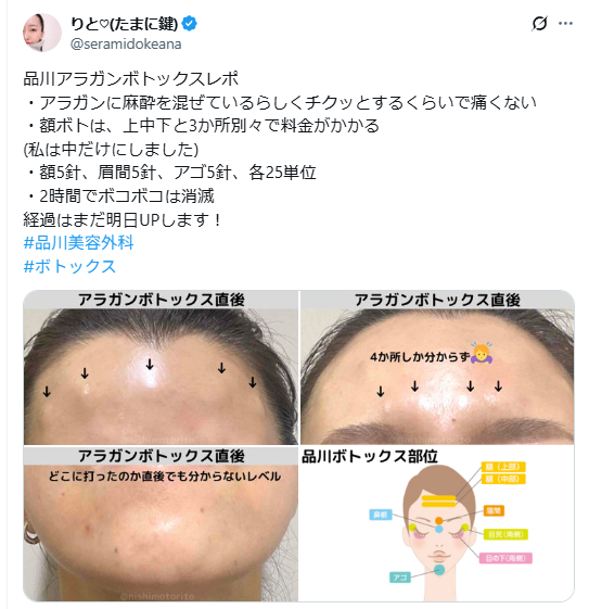 ボトックス　ボコボコ