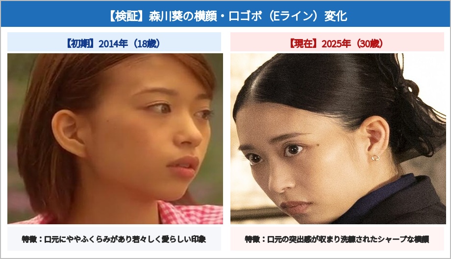 森川葵の横顔・口元・Eライン比較画像 デビュー初期と現在の口ゴボ変化