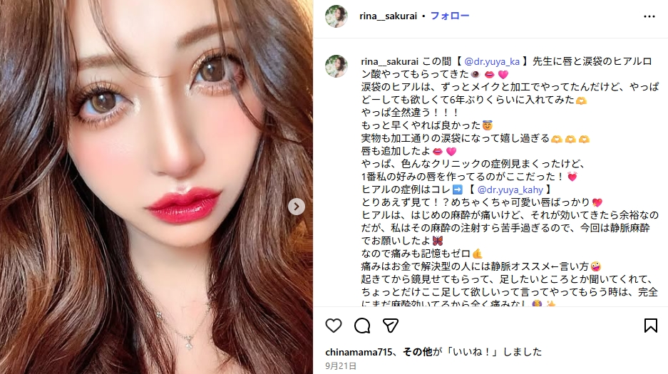 桜井莉菜（さくりな）　整形　顔変わった